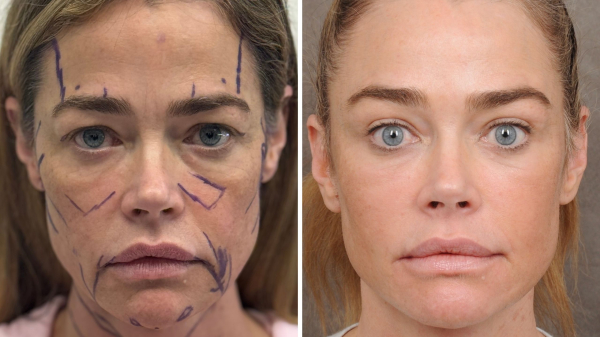Denise Richards’ Raw Facelift Before-and-After Photos Are the Transparency We Need